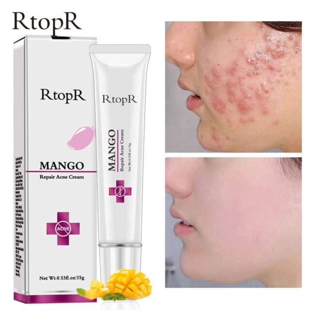 Mango Anti-Akne Creme – Entfernt Pickel & Verkleinert Poren 15g – Bild 2