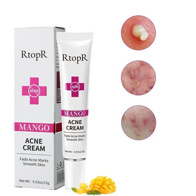 Mango Anti-Akne Creme – Entfernt Pickel & Verkleinert Poren 15g